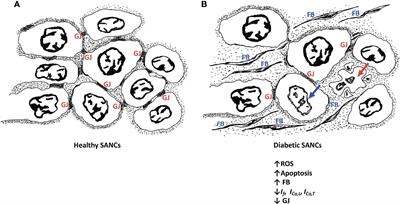 Structural and Electrical Remodeling of the Sinoatrial Node in Diabetes: New Dimensions and Perspectives